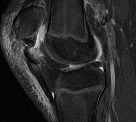 Figure 4 for case Patellar sleeve avulsion
